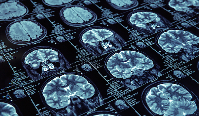 Xray Image of brain -artificial-intelligence-in-radiology.jpg